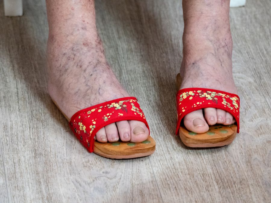 Chronisch venöse Insuffizienz (CVI): Ursachen, Symptome, Behandlung