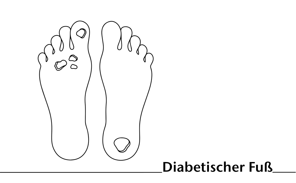 Behandlung des diabetischen Fußsyndroms (DFS): Fokus diabetisches Fußulkus (DFU)